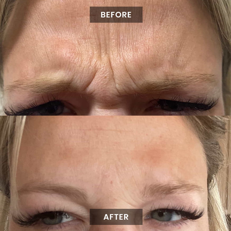 puretox-before-after-2
