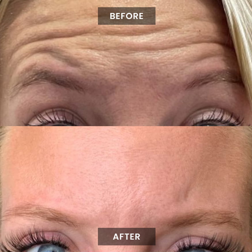 puretox-before-after-3